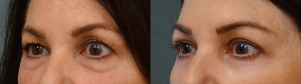 Upper and Lower Eyelids with Chemical Peel Patient 10-C 