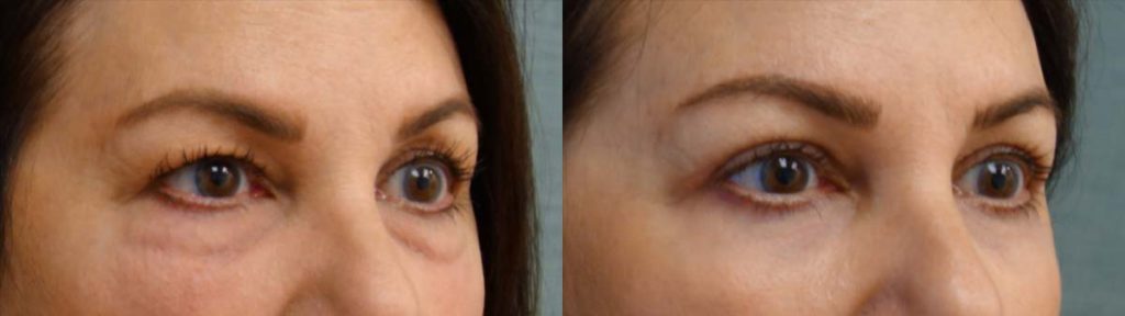 Upper and Lower Eyelids with Chemical Peel Patient 10-B 