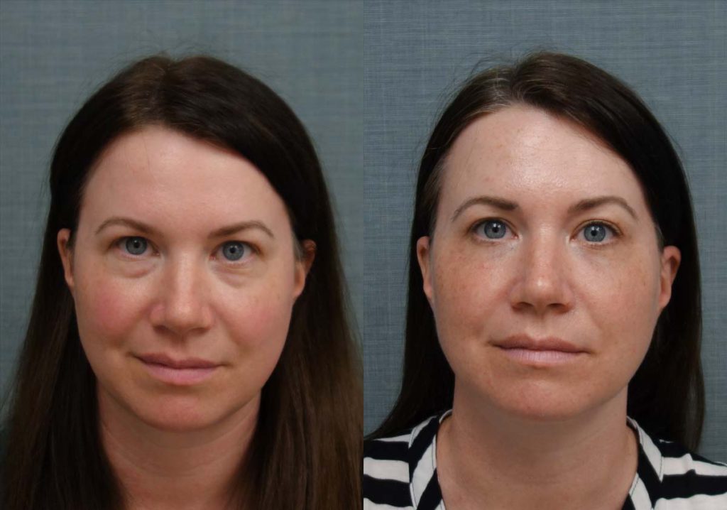 Lower Eyelid Blepharoplasty, Facial Fat Grafting, Eyelid Laser Resurfacing Patient 12-A 