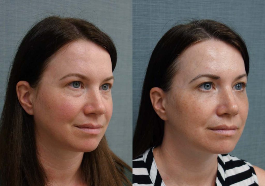 Lower Eyelid Blepharoplasty, Facial Fat Grafting, Eyelid Laser Resurfacing Patient 12-B 