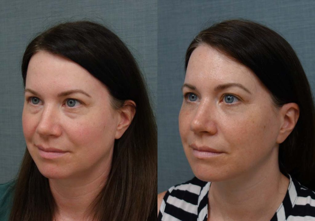 Lower Eyelid Blepharoplasty, Facial Fat Grafting, Eyelid Laser Resurfacing Patient 12-C 