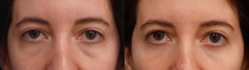 Lower Eyelid Blepharoplasty with Chemical Peel, Facial Fat Grafting Patient 16-A 