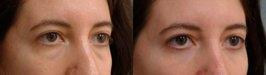 Lower Eyelid Blepharoplasty with Chemical Peel, Facial Fat Grafting Patient 16-B 