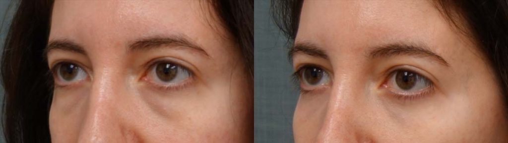 Lower Eyelid Blepharoplasty with Chemical Peel, Facial Fat Grafting Patient 16-C 