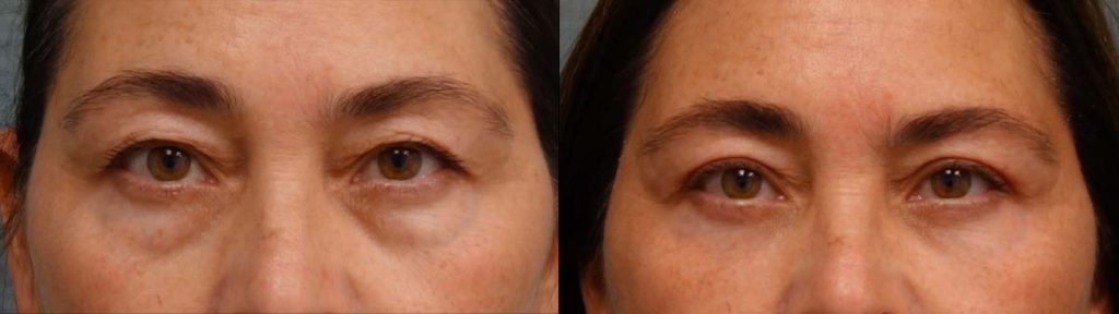 Upper and Lower Eyelid Blepharoplasty, Eyelid Laser Resurfacing Patient 18-A 