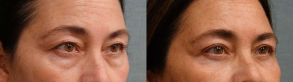 Upper and Lower Eyelid Blepharoplasty, Eyelid Laser Resurfacing Patient 18-B 