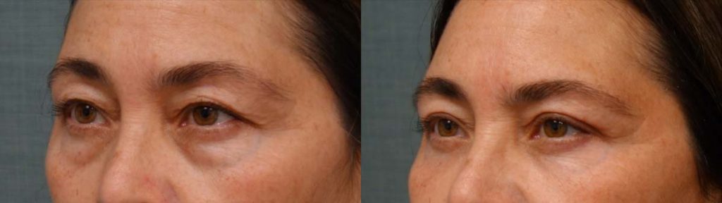 Upper and Lower Eyelid Blepharoplasty, Eyelid Laser Resurfacing Patient 18-C 