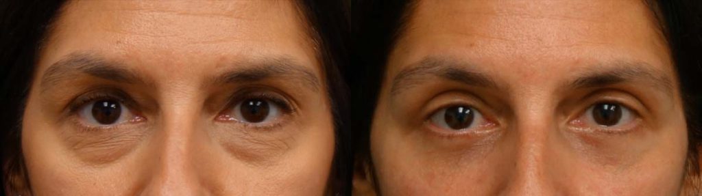 Upper and Lower Eyelid Blepharoplasty, Eyelid Laser Resurfacing Patient 22-A 