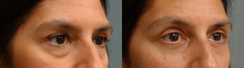 Upper and Lower Eyelid Blepharoplasty, Eyelid Laser Resurfacing Patient 22-B 