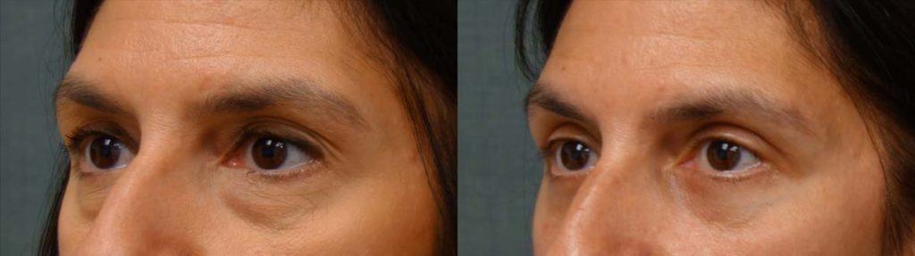 Upper and Lower Eyelid Blepharoplasty, Eyelid Laser Resurfacing Patient 22-C 