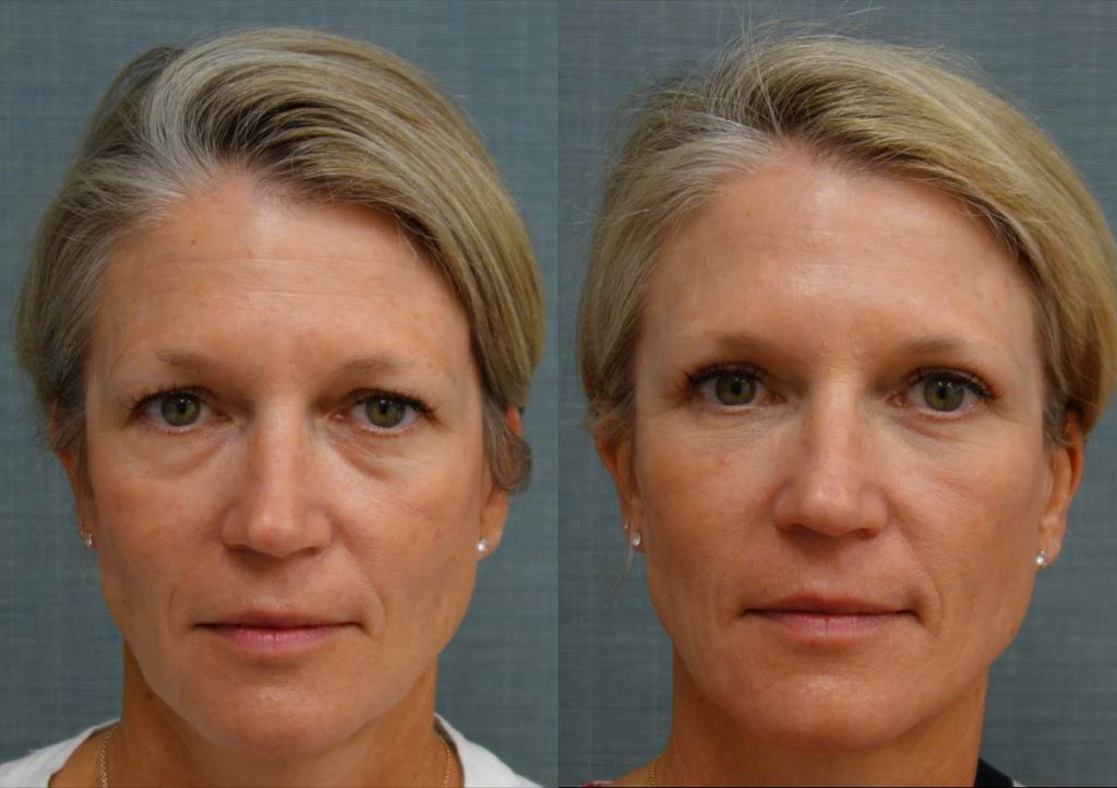 Upper and Lower Eyelid Blepharoplasty with Internal Cheek Elevation, Eyelid Laser Resurfacing Patient 25-A 