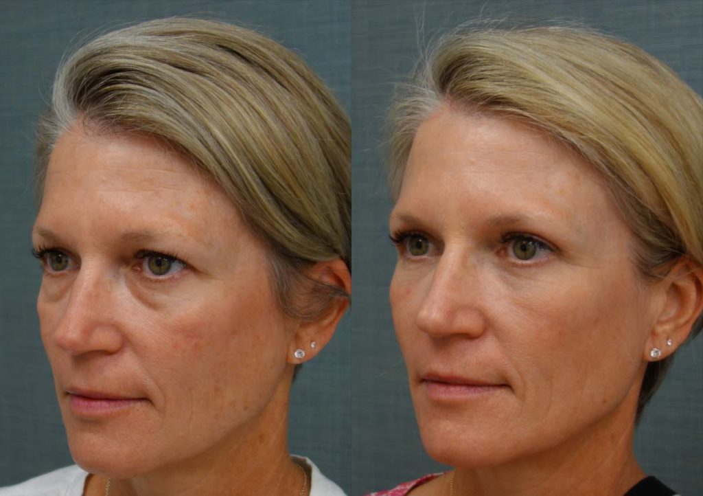 Upper and Lower Eyelid Blepharoplasty with Internal Cheek Elevation, Eyelid Laser Resurfacing Patient 25-C 