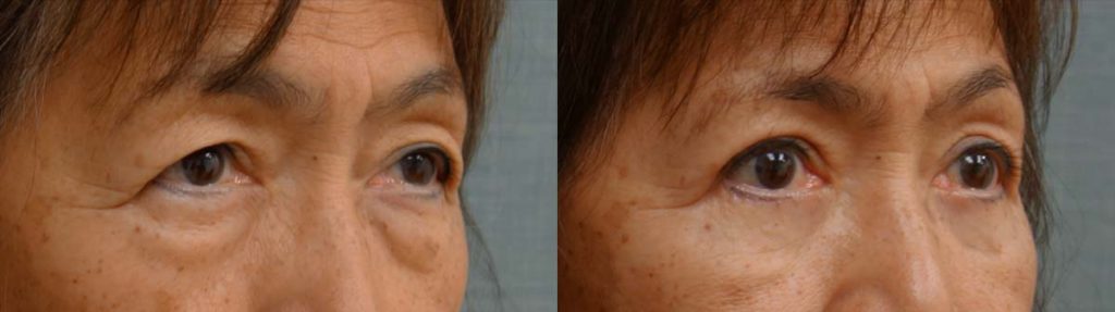 Upper and Lower Eyelid Blepharoplasty Patient 26-A 