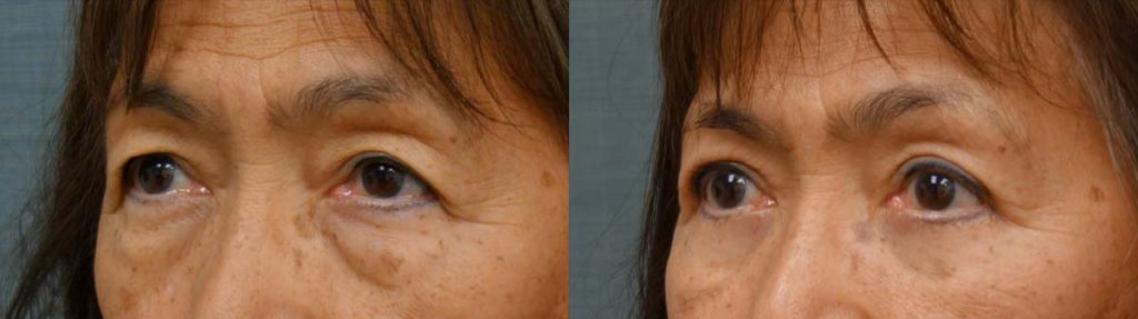 Upper and Lower Eyelid Blepharoplasty Patient 26-B 