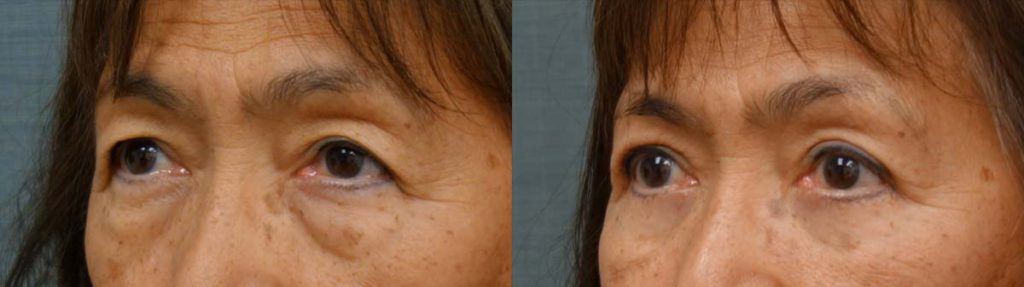 Upper and Lower Eyelid Blepharoplasty Patient 26-B 