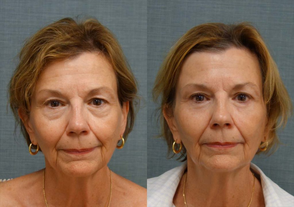 Upper and Lower Eyelid Blepharoplasty, Eyelid Laser Resurfacing Patient 33-A 