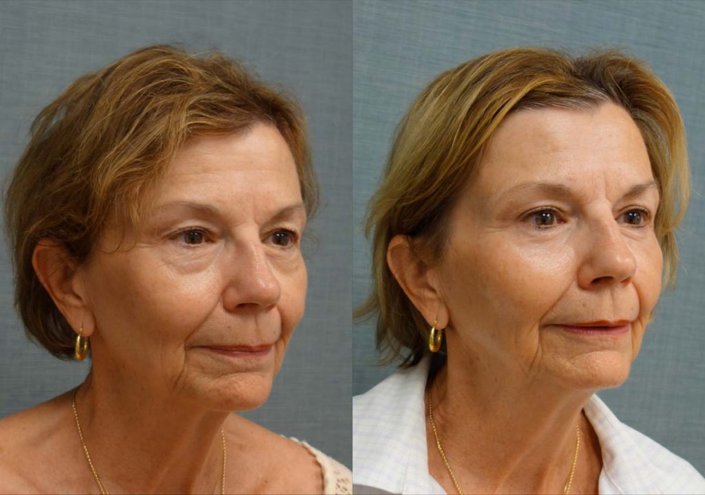 Upper and Lower Eyelid Blepharoplasty, Eyelid Laser Resurfacing Patient 33-B 