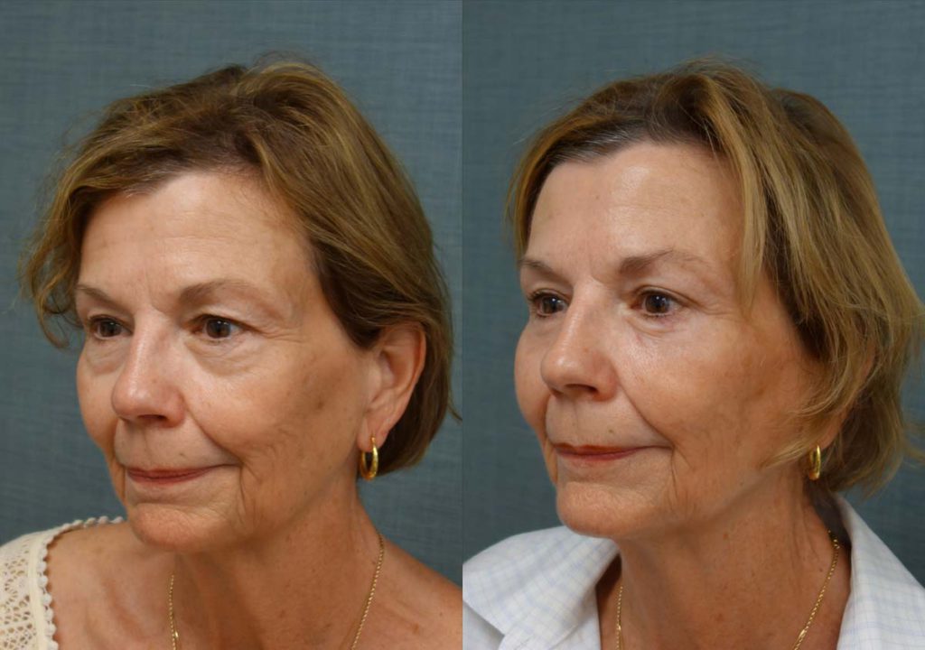 Upper and Lower Eyelid Blepharoplasty, Eyelid Laser Resurfacing Patient 33-C 