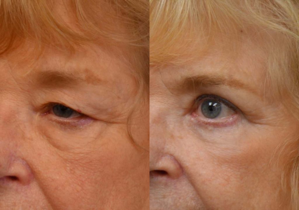 Upper and Lower Eyelid Blepharoplasty, Eyelid Laser Resurfacing Patient 28 