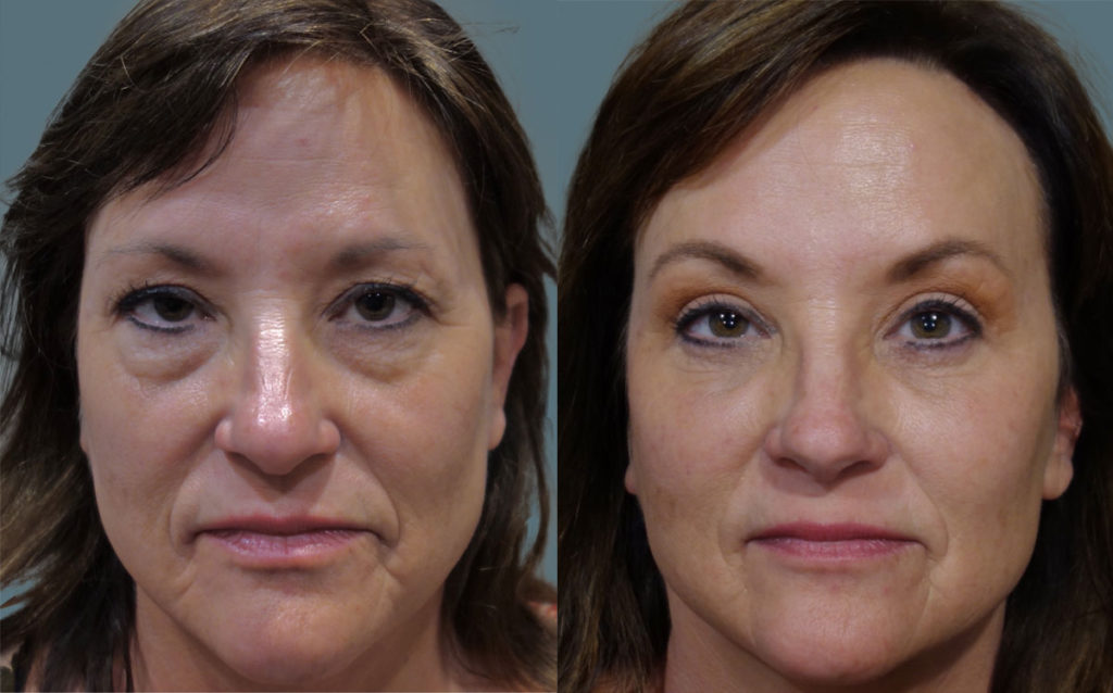 Bilateral Upper and Lower Eyelid Blepharoplasty, Mini Brow Lift, Chemical Peel and Lower Face Filler Patient 19-A 