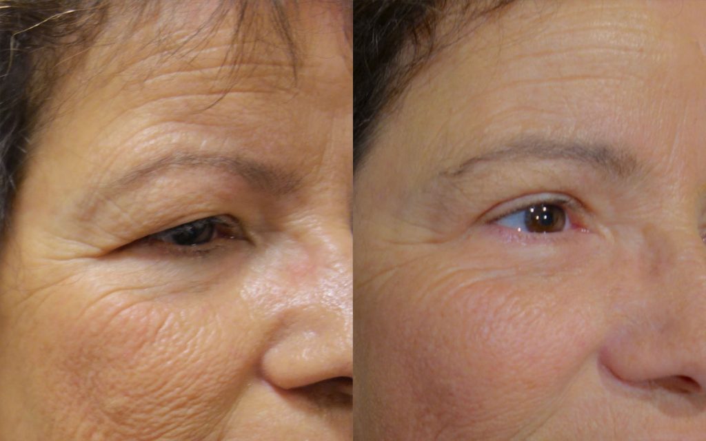 Upper Eyelid Blepharoplasty and Lateral Brow Lift Patient 18-A 