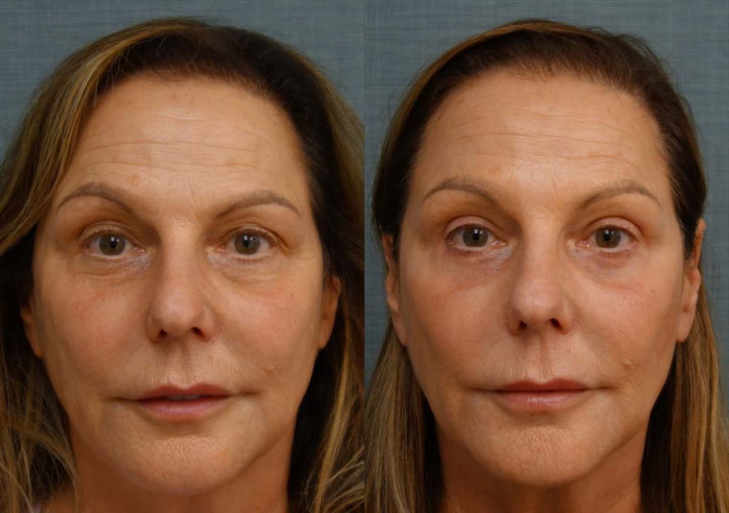 Upper and Lower Eyelid Blepharoplasty, Left Mini Brow Lift, Chemical Peel Patient 29-A 