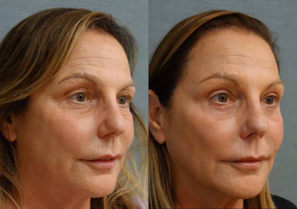 Upper and Lower Eyelid Blepharoplasty, Left Mini Brow Lift, Chemical Peel Patient 29-B 