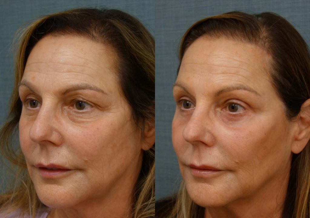 Upper and Lower Eyelid Blepharoplasty, Left Mini Brow Lift, Chemical Peel Patient 29-C 