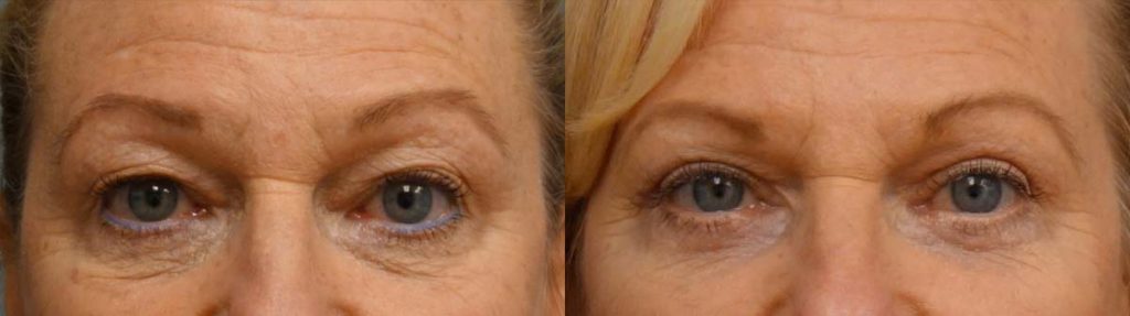 Upper and Lower Eyelid Blepharoplasty, Eyelid Laser Resurfacing Patient 32-A 