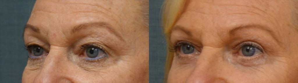 Upper and Lower Eyelid Blepharoplasty, Eyelid Laser Resurfacing Patient 32-C 