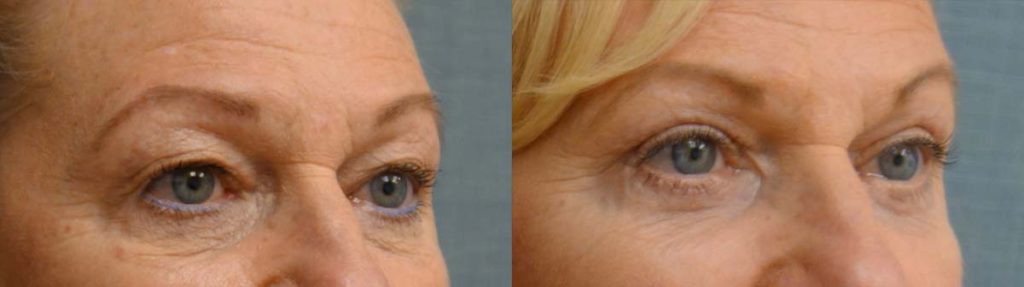 Upper and Lower Eyelid Blepharoplasty, Eyelid Laser Resurfacing Patient 32-B 