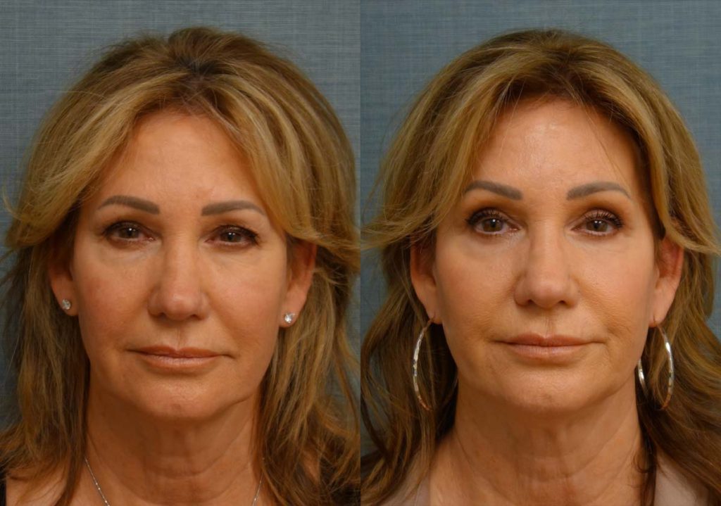 Upper and Lower Eyelid Blepharoplasty, Eyelid Laser Resurfacing Patient 34-A 