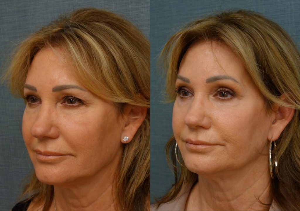 Upper and Lower Eyelid Blepharoplasty, Eyelid Laser Resurfacing Patient 34-B 