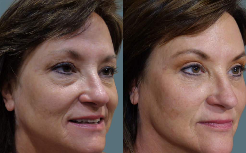 Bilateral Upper and Lower Eyelid Blepharoplasty, Mini Brow Lift, Chemical Peel and Lower Face Filler Patient 19-B 
