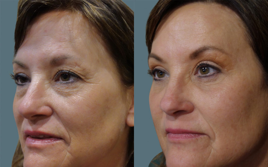 Bilateral Upper and Lower Eyelid Blepharoplasty, Mini Brow Lift, Chemical Peel and Lower Face Filler Patient 19-C 