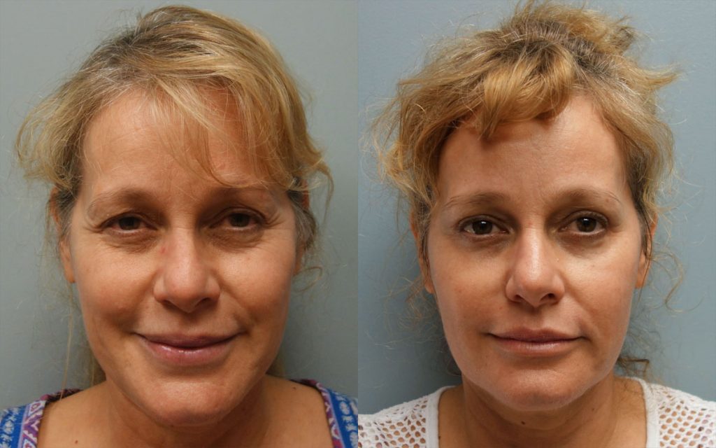 Upper Eyelid Blepharoplasty, Mini Brow Lift and Laser Resurfacing Patient 08-A 