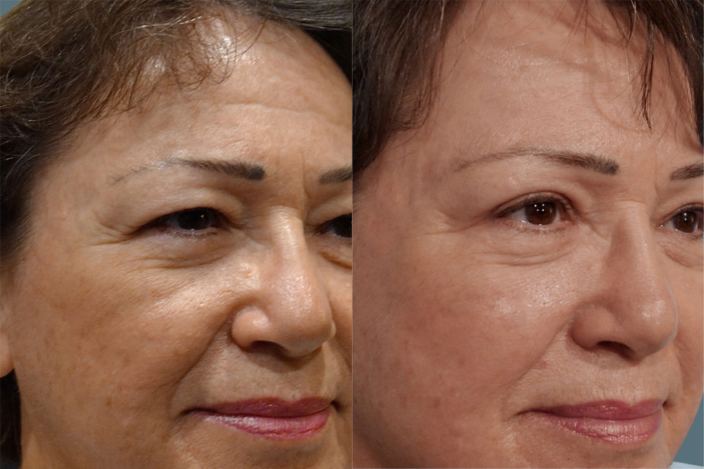 Bilateral Upper Eyelid Surgery Patient 25 