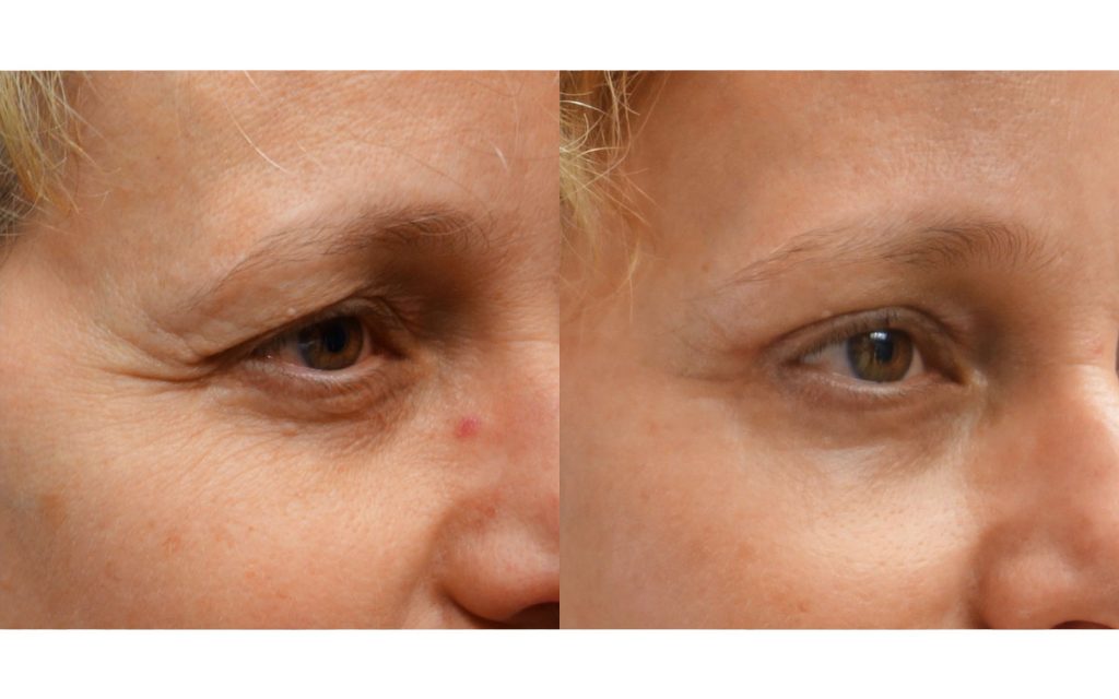 Upper Eyelid Blepharoplasty, Mini Brow Lift and Laser Resurfacing Patient 08-B 