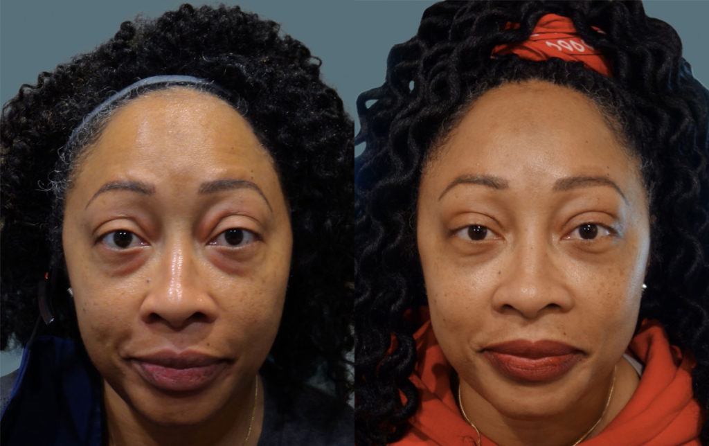 Bilateral Upper and Lower Eyelid Blepharoplasty Patient 46-A 