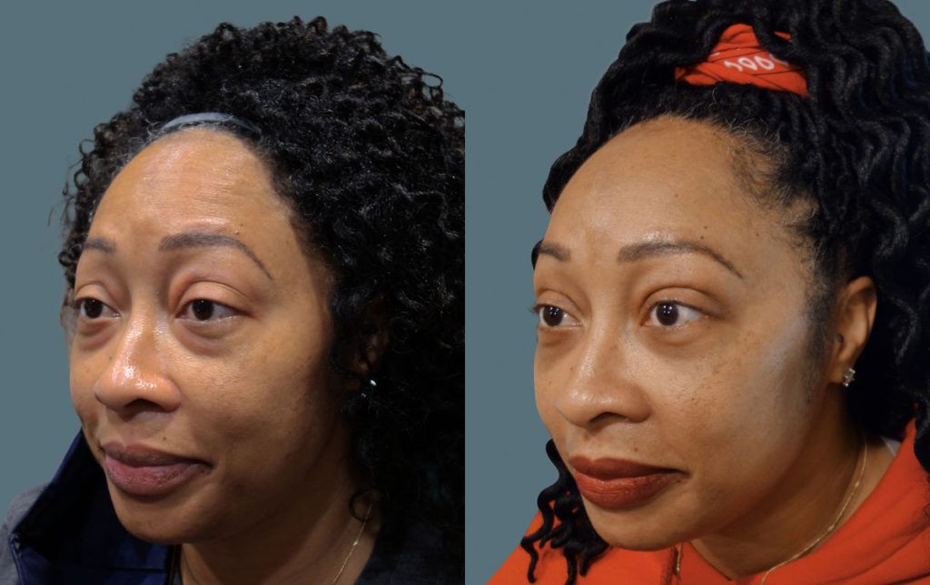 Bilateral Upper and Lower Eyelid Blepharoplasty Patient 46-B 