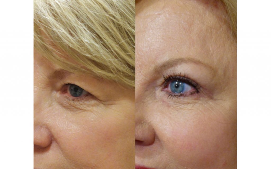Upper Eyelid Blepharoplasty and Mini Temporal Brow Lift Patient 18-B 