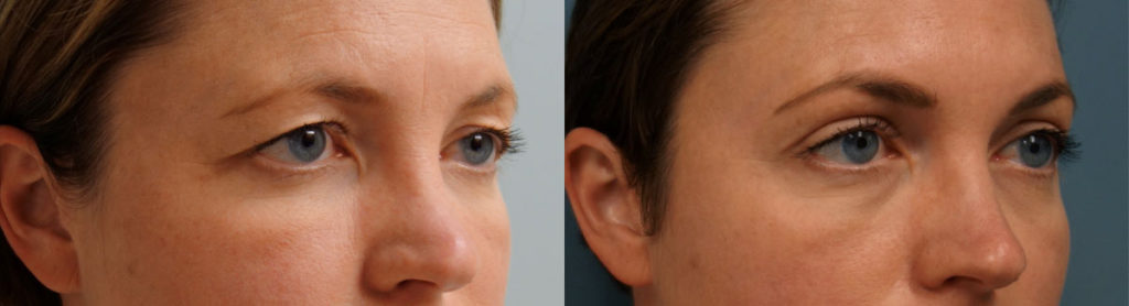 Bilateral Upper Blepharoplasty, Mini Brow Lift, Left Upper Eyelid Internal Ptosis Repair Patient 04-A 