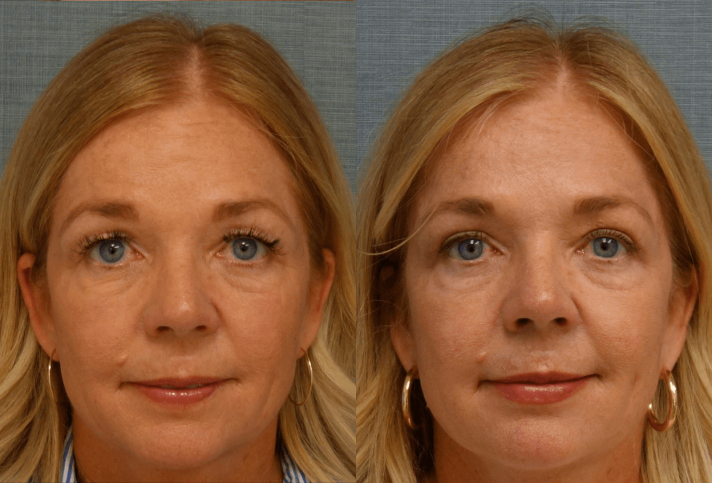 Upper Eyelid Blepharoplasty, Mini Brow Lift Patient 49-A 