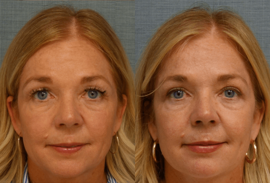 Upper Eyelid Blepharoplasty, Mini Brow Lift Patient 50-A 