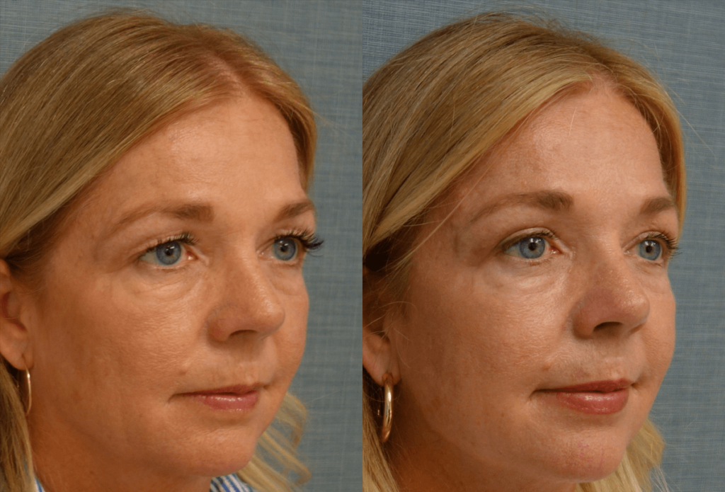 Upper Eyelid Blepharoplasty, Mini Brow Lift Patient 49-B 