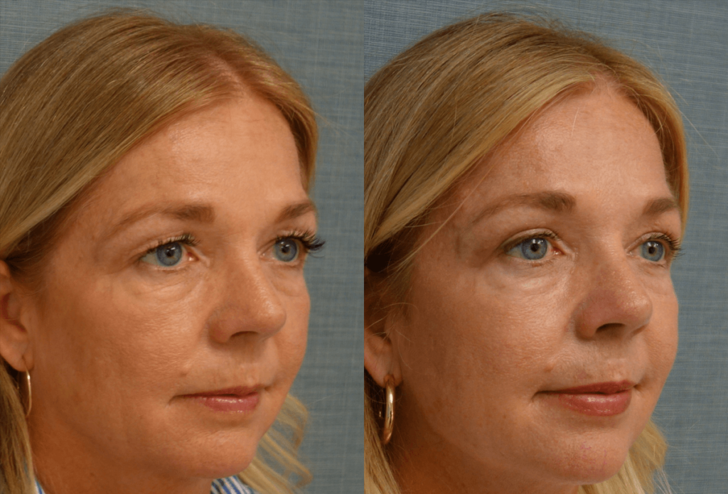 Upper Eyelid Blepharoplasty, Mini Brow Lift Patient 50-B 