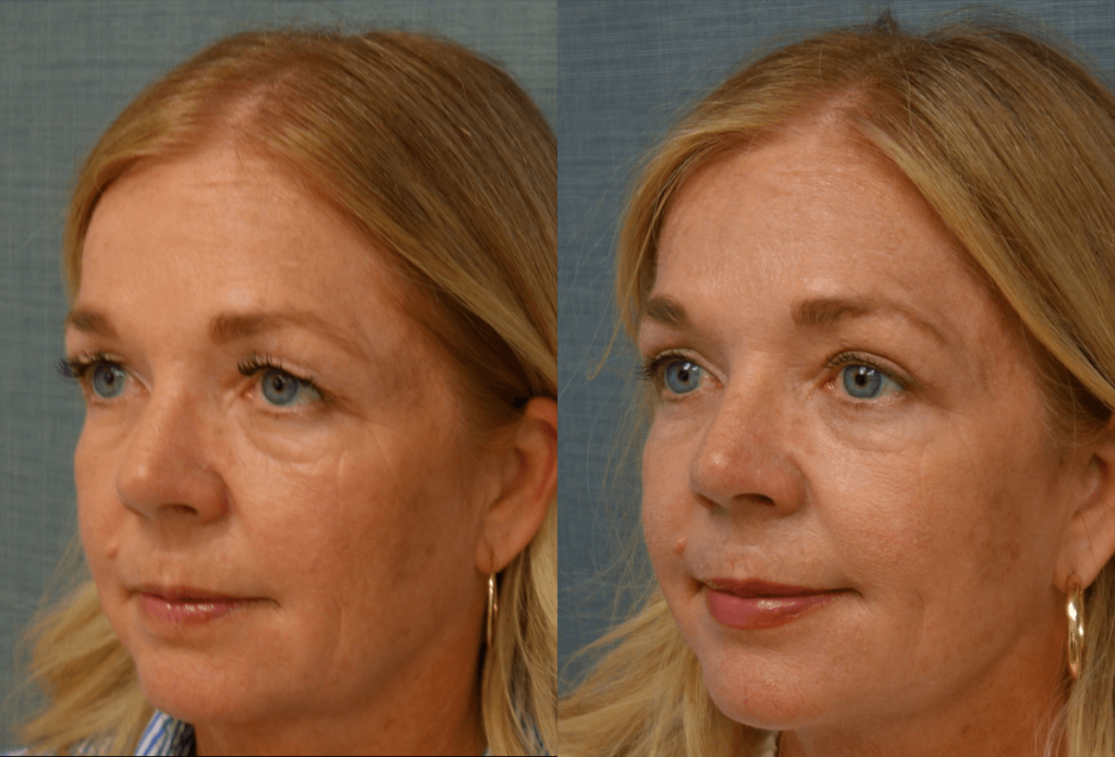 Upper Eyelid Blepharoplasty, Mini Brow Lift Patient 49-C 