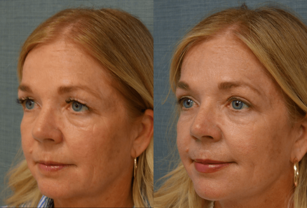 Upper Eyelid Blepharoplasty, Mini Brow Lift Patient 50-C 