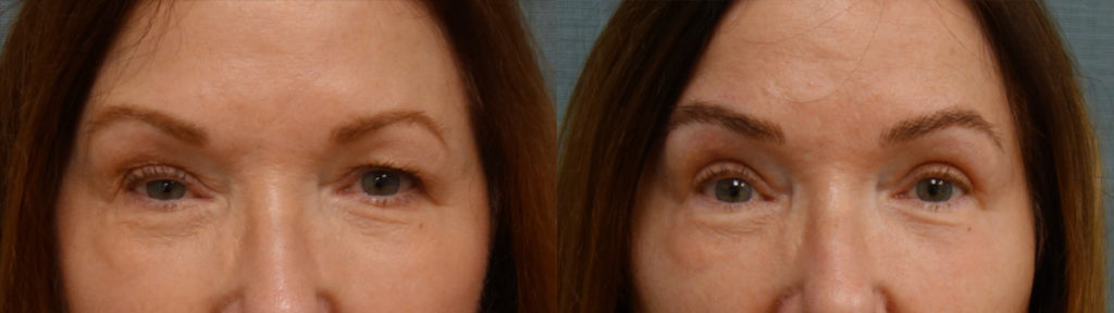 Bilateral Upper Eyelid Blepharoplasty, Left Mini Brow Lift, Right Upper Eyelid Internal Ptosis Repair, Chemical Peel to Bilateral Lower Eyelids Patient 23-A Bilateral Upper Eyelid Blepharoplasty, Left Mini Brow Lift, Right Upper Eyelid Internal Ptosis Repair, Chemical Peel to Bilateral Lower Eyelids Patient 23-A