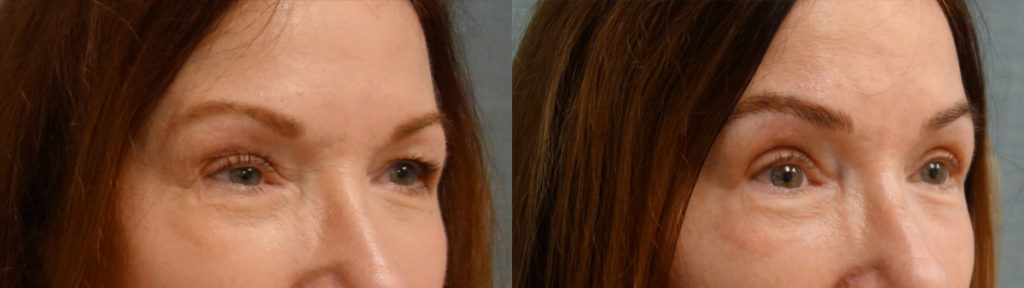 Bilateral Upper Eyelid Blepharoplasty, Left Mini Brow Lift, Right Upper Eyelid Internal Ptosis Repair, Chemical Peel to Bilateral Lower Eyelids Patient 23-B Bilateral Upper Eyelid Blepharoplasty, Left Mini Brow Lift, Right Upper Eyelid Internal Ptosis Repair, Chemical Peel to Bilateral Lower Eyelids Patient 23-B
